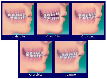 teeth braces before and after. Braces+efore+and+after+