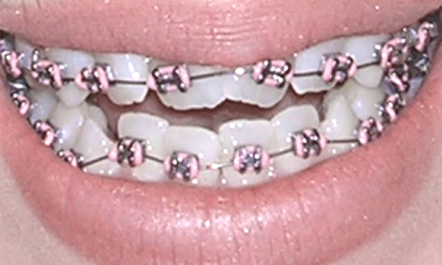 braces before and after braces photos. Pam#39;s teeth efore braces.