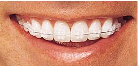 manufactured by Ormco,