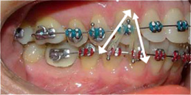 elastics teeth orthodontic bring together touching help shape