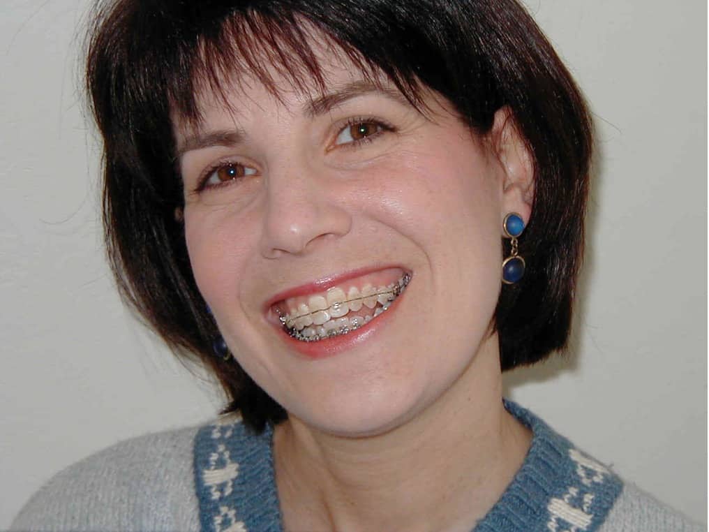 Lynn Starting Braces Treatment