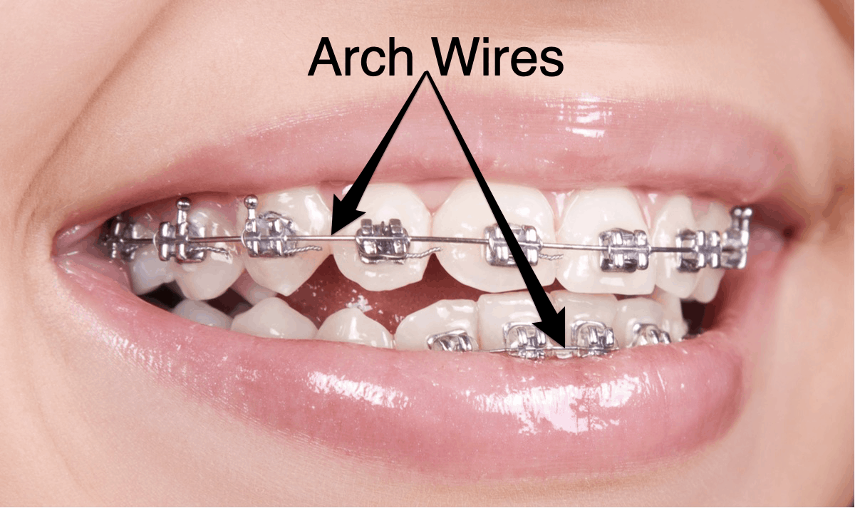 All About Orthodontic Arch Wires - ArchWired