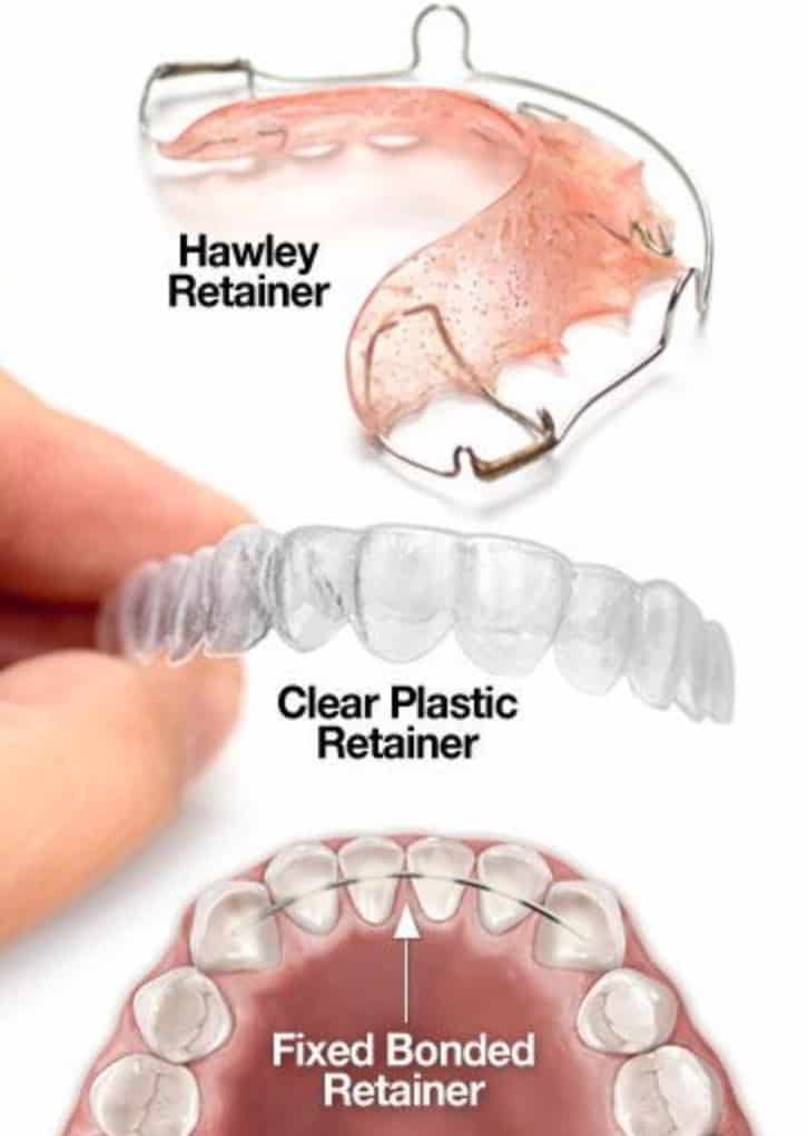 Life After Braces: Wire Vs Plastic Retainers