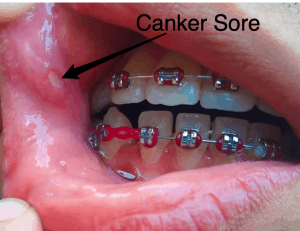 canker sore braces sores ouch archwired hates