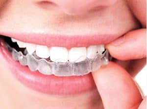 What Are Lingual Braces? - ArchWired