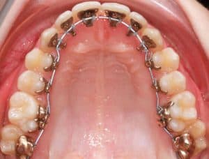 Lingual-Braces