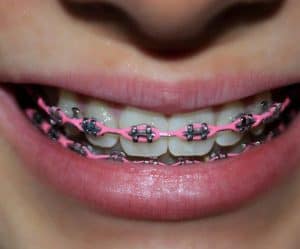 All About Orthodontic Power Chains - ArchWired