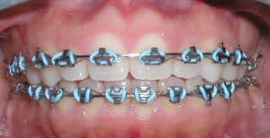 Viazi-Brackets