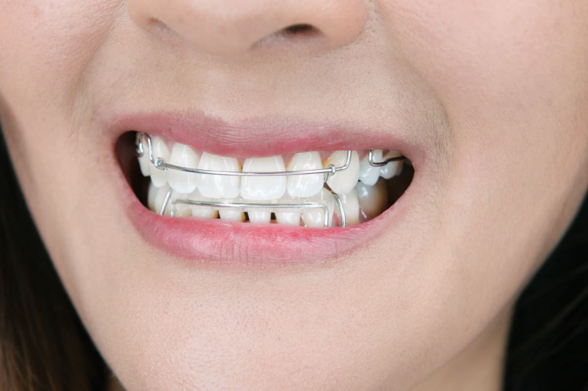 Life After Braces: Wire Vs Plastic Retainers