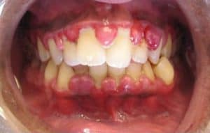 Gingivitis_crop