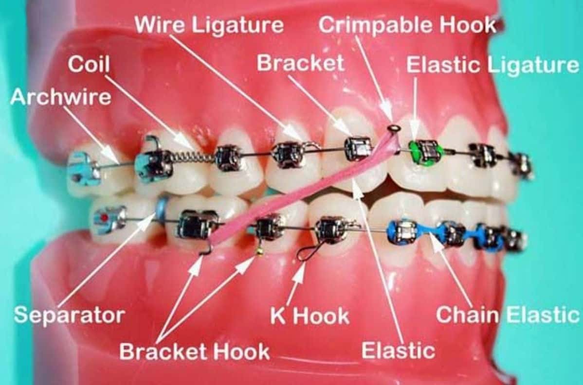 What Is An Orthodontic Tie Wire On Braces? - ArchWired