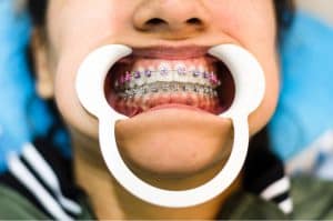 Cheek_Retractor