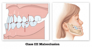 Class_III_Malocclusion