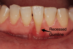 Gum_Recession