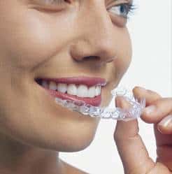 What Are Clear Invisible Aligners or Invisible Braces? - ArchWired