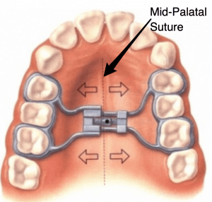 Mid-Palatal-Suture