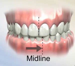 What Is A Midline Of Teeth In Orthodontics? - ArchWired