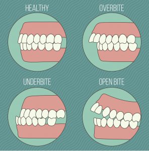 Types_Of_Bites
