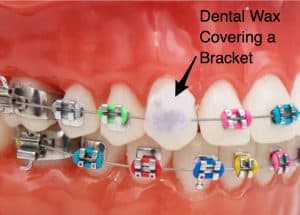 Wax_On_Braces-1