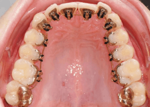 Lingual-Braces