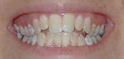 My_Teeth_Before_Zoomed2