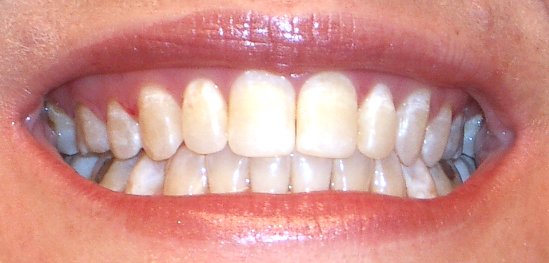 New_Teeth_CU